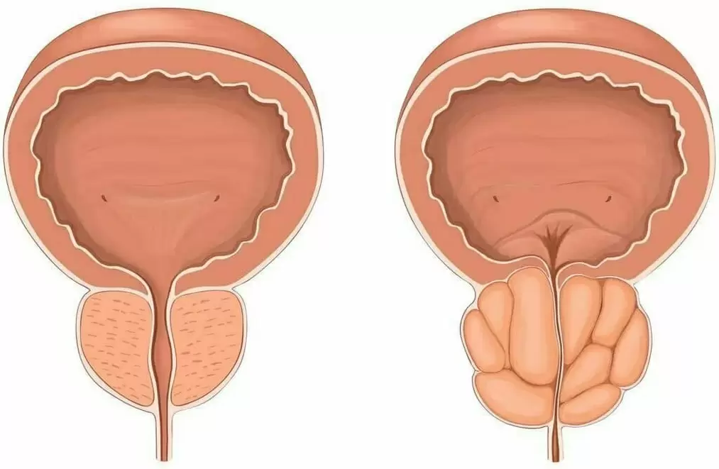 prostata normala si prostata bolnava